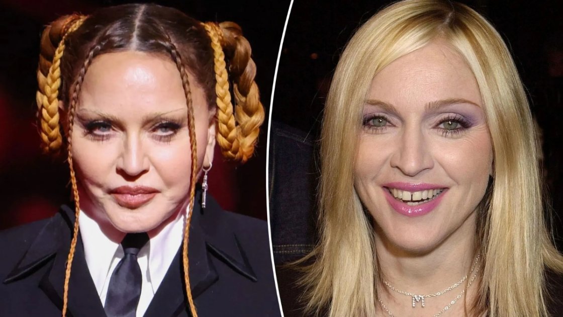 Madonnaâ€™s Botox Treatment