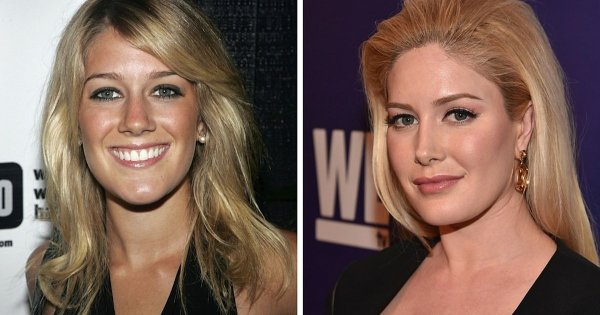 Heidi Montag Nearly Lost Her Life After Undergoing Ten Simultaneous Plastic Surgeries