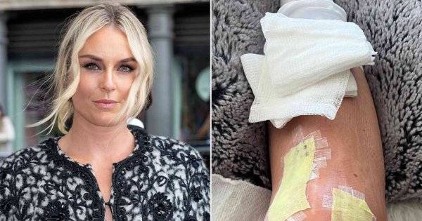 Lindsey Vonn Has Recently Disclosed Her Intention To Undergo Knee Replacement Surgery As Part Of Her Medical Treatment